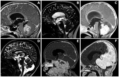 The Clinical and Prognostic Impact of the Choice of Surgical Approach to Fourth Ventricular Tumors in a Single-Center, Single-Surgeon Cohort of 92 Consecutive Pediatric Patients